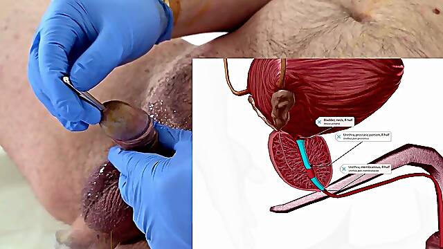 2nd time attempting urethral sounding and reviewing anatomy