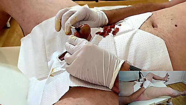 18 French Foley Catheter Insertion